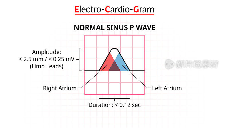 P波- ECG窦性正常-心电图-形态P波